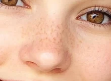 Freckles